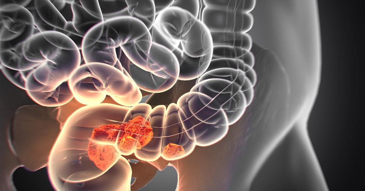 Cancer de colon – metode de preventie prin screening medical