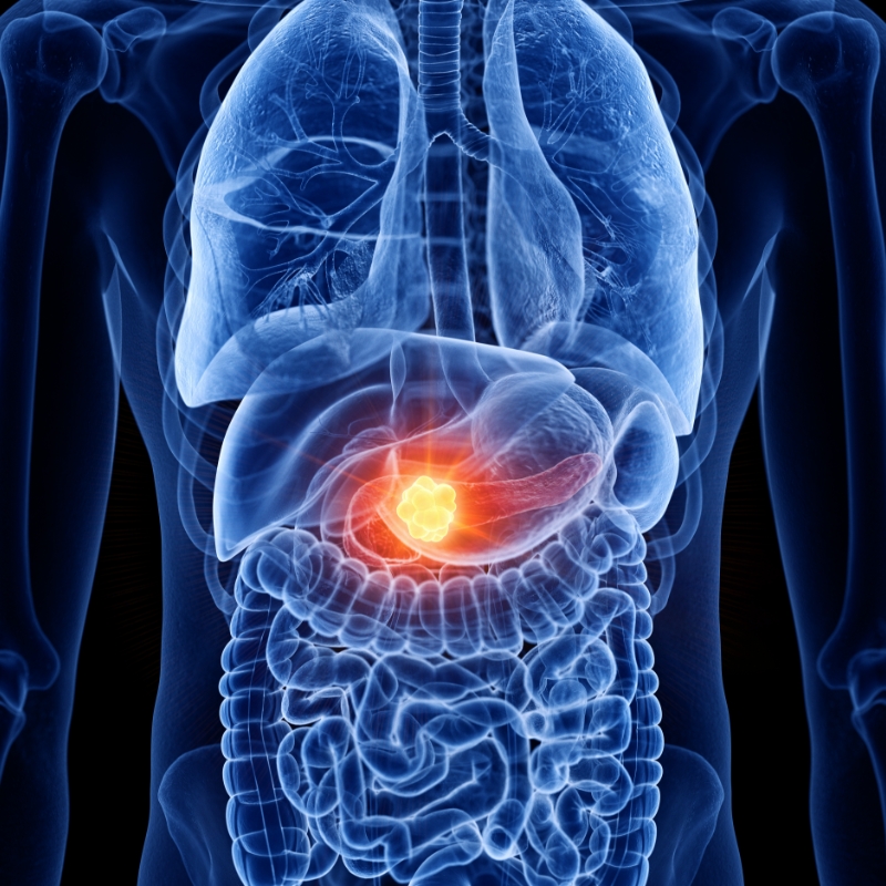 Cancerul de pancreas